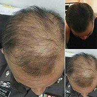 นีโอแฮร์ ซื้อที่ไหน